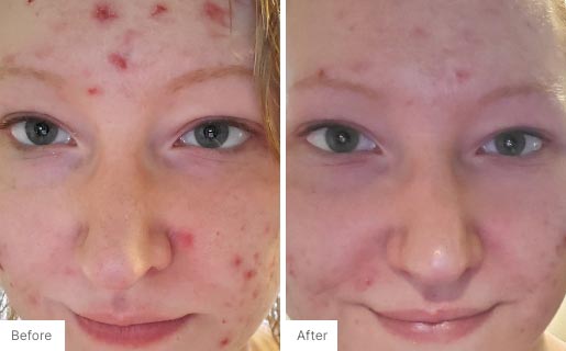 2 - Before and After Real Results photo of a woman's use of Neora's Acne Complexion Treatment Pads