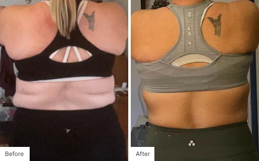 8 - Before and After of a woman's back using NeoraFit.